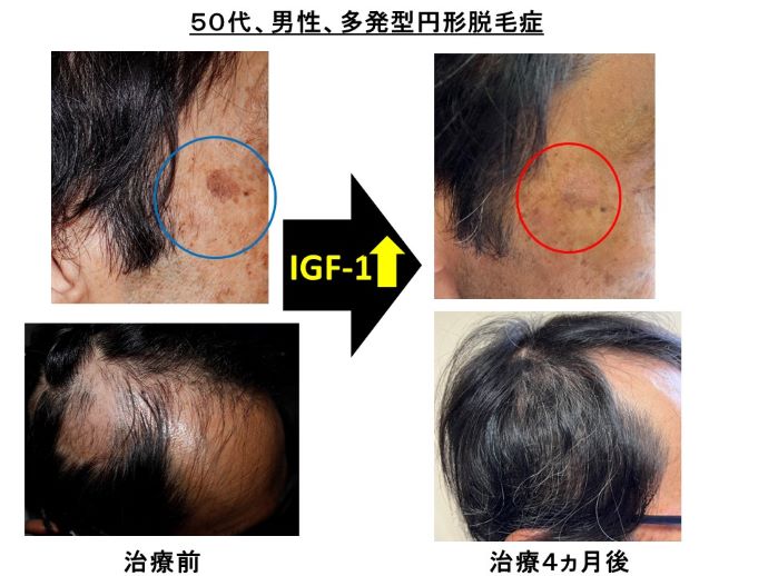 円形脱毛症　病院